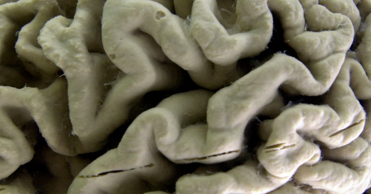 New Blood Test Identifies Healthy People at High Risk for Alzheimer's Disease