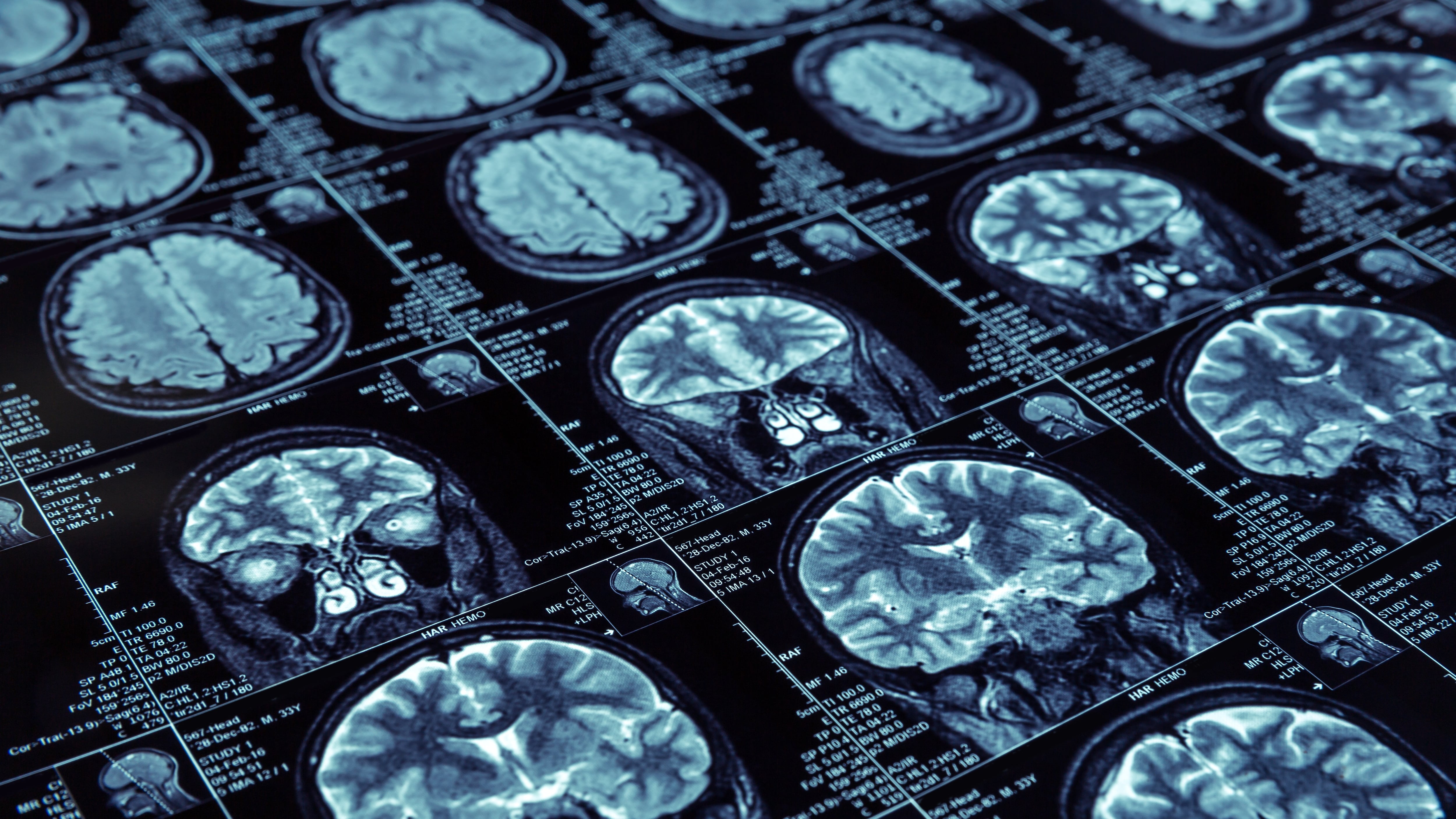 Chronic Traumatic Encephalopathy: Understanding Brain Damage Linked to Repeated Head Injuries in Sports