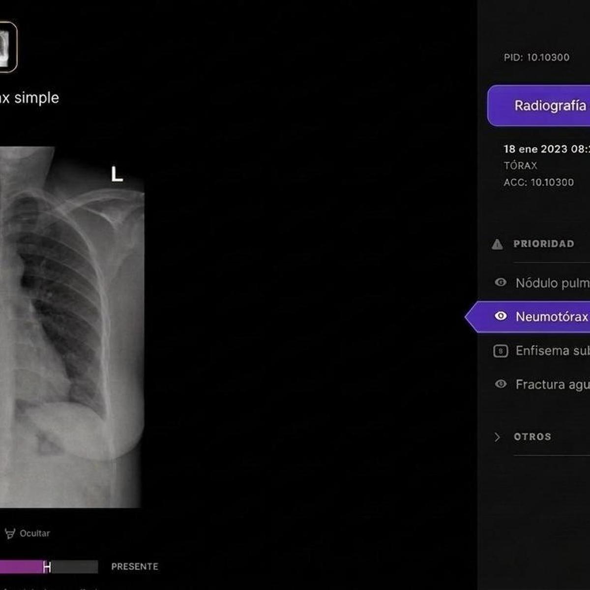 Telefónica's tech subsidiary expands healthcare presence with AI-powered rapid X-ray diagnostics in Spain.