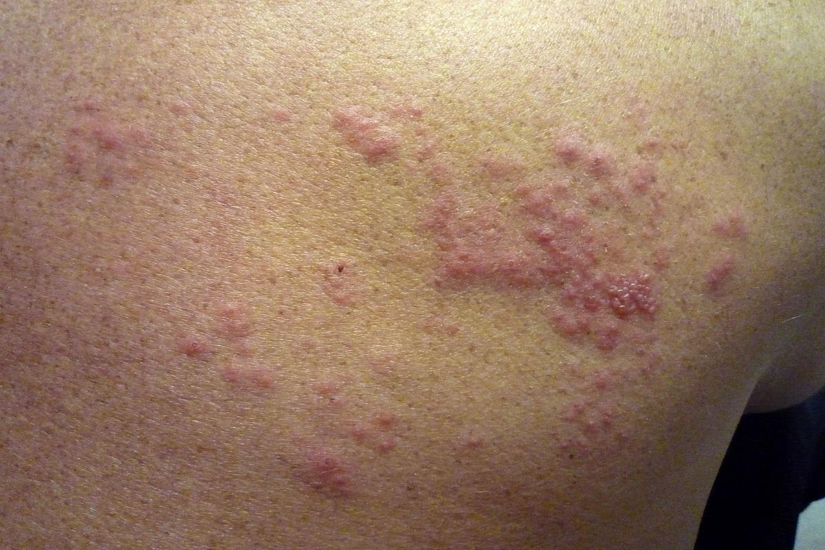 Shingles: The Disease 30% of People Will Experience, Linked to Childhood Chickenpox