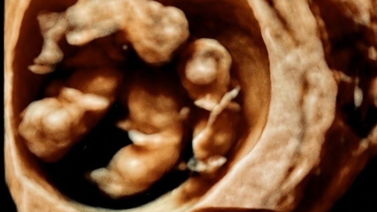 Brisbane hospital celebrates birth of naturally conceived identical quadruplets, a one-in-15-million event