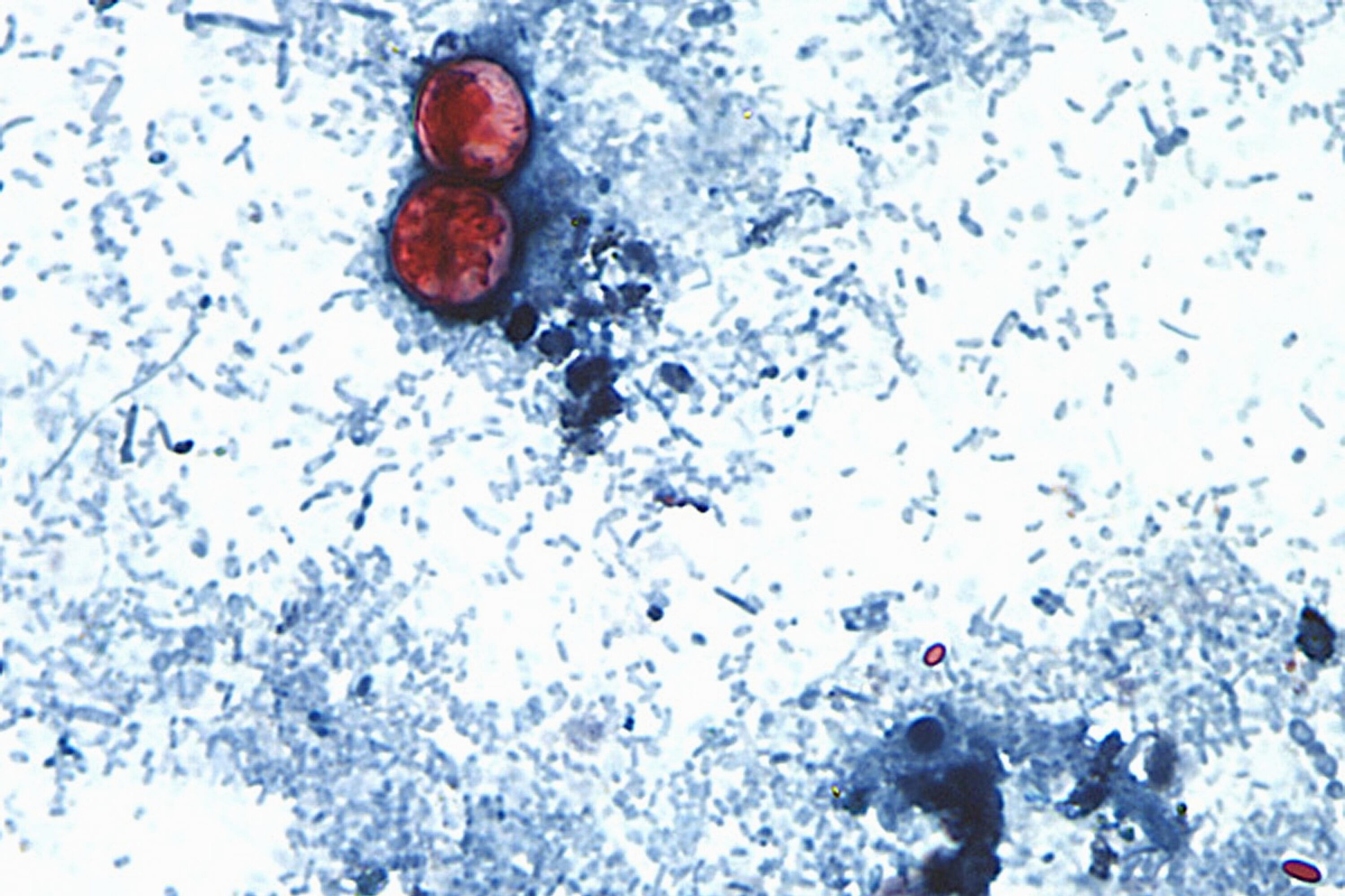 US Health Officials Confirm Cyclospora Outbreak Involving Iceberg Lettuce in Twenty States
