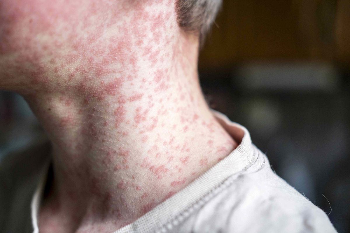 Measles Cases Rise Across Multiple States as Health Officials Urge Vaccinations