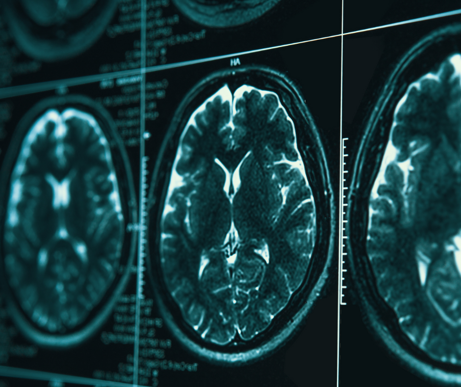 Study Links Disadvantaged Neighborhoods to Accelerated Brain Aging in Adults