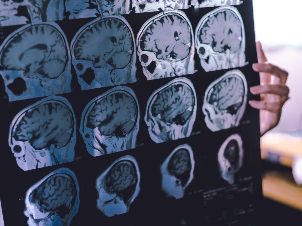 Addressing Fourteen Modifiable Risk Factors Can Significantly Reduce Dementia Risk Over Time