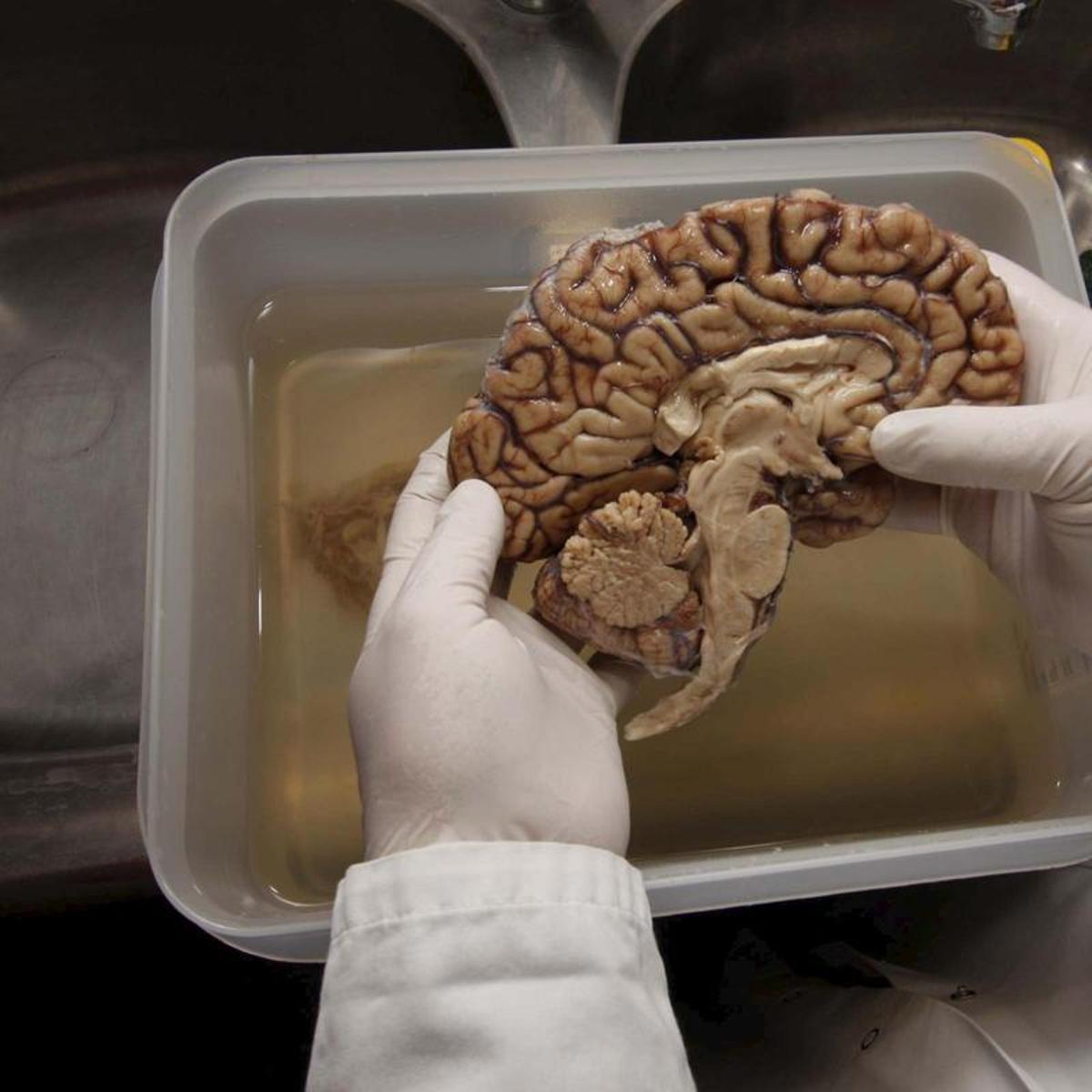 Nuevas investigaciones revelan que células del sistema inmune influyen en el alzhéimer