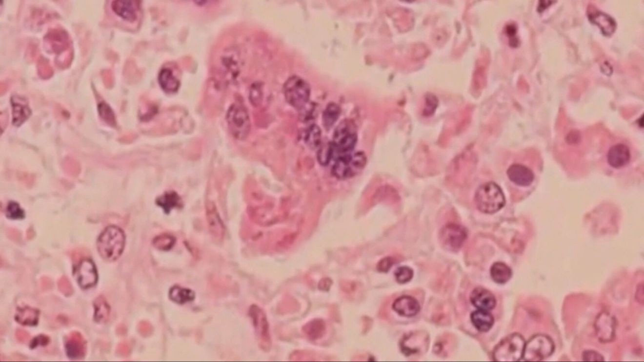 Pennsylvania Measles Outbreak Reaches 731 Cases, Four Deaths