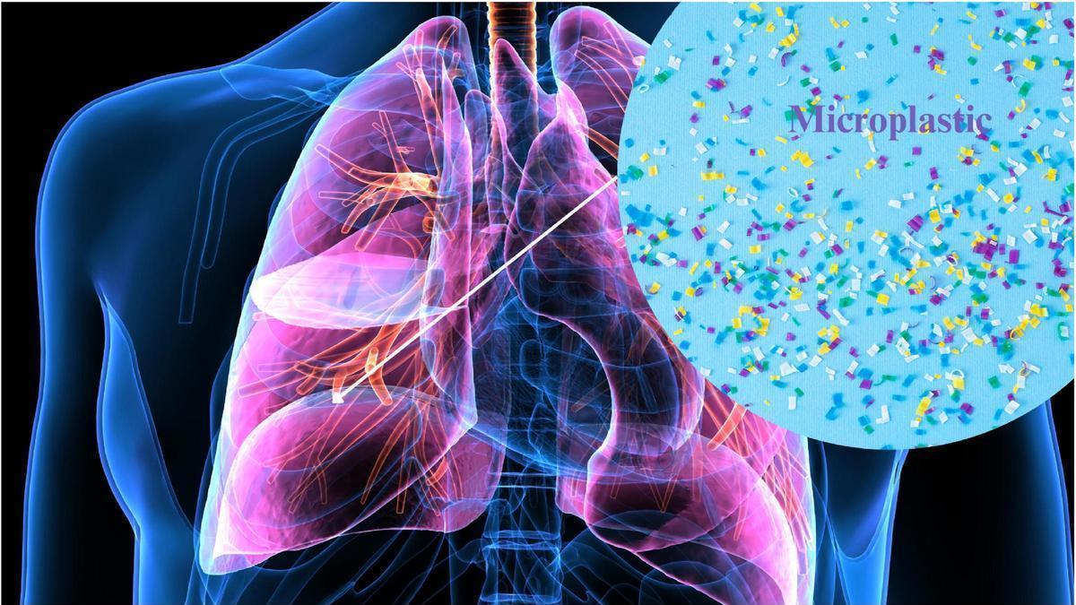 Nueva investigación médica detecta niveles elevados de microplásticos en pulmones con cáncer