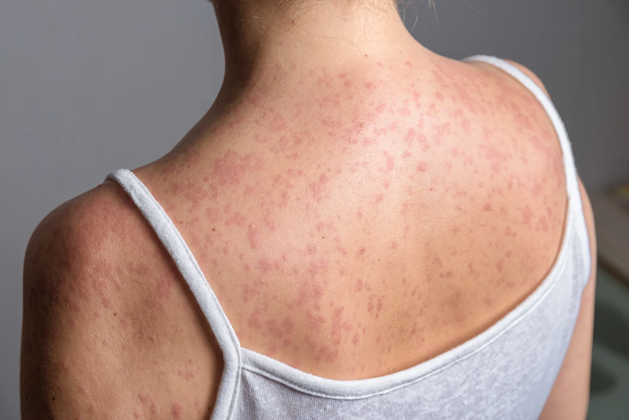 Wisconsin measles outbreak spreads to Chippewa County as statewide total reaches 168 cases.