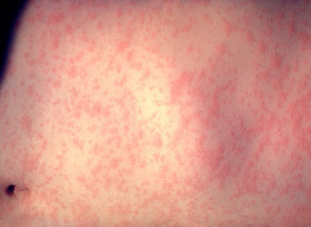 Wisconsin Health Officials Confirm New Measles Case in Marathon County