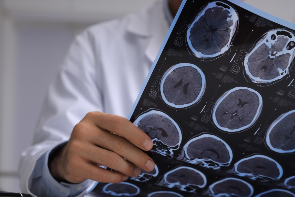 New Research Reveals T Cells Outside the Brain Drive Alzheimer's Damage