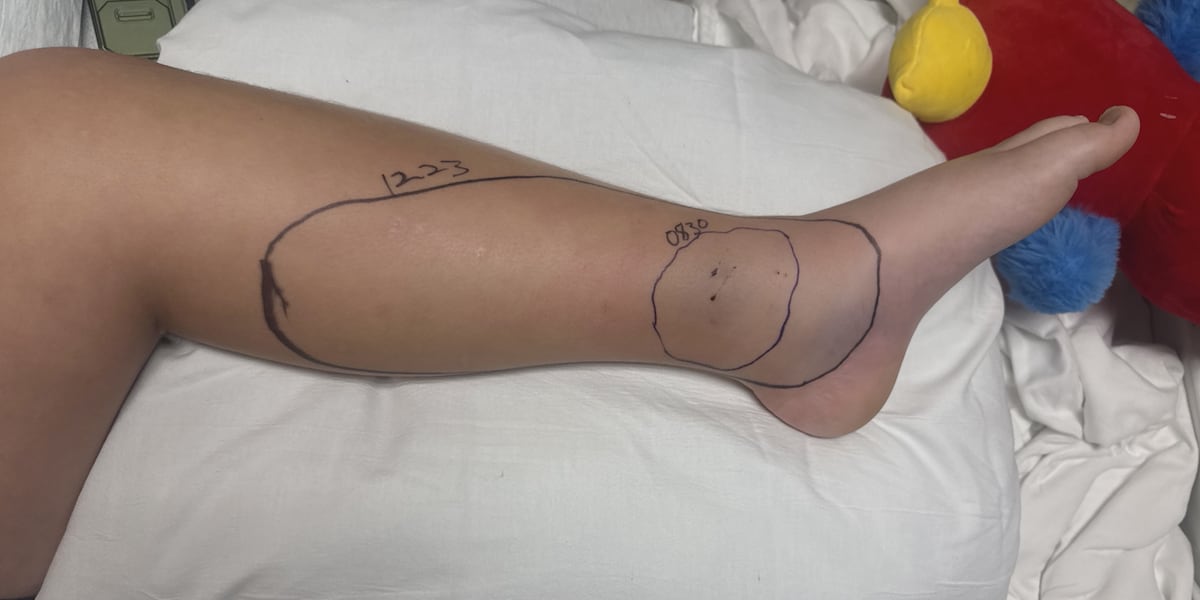 Missouri Boy Recovers at Home After Copperhead Snake Bite at Lake