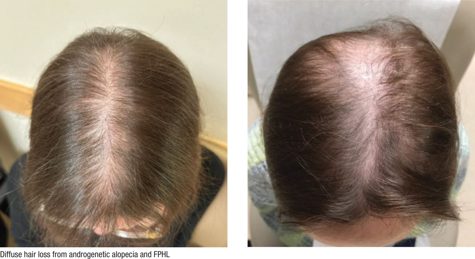 Hair experts explain thinning hair linked to rapid weight loss and advanced restoration techniques.