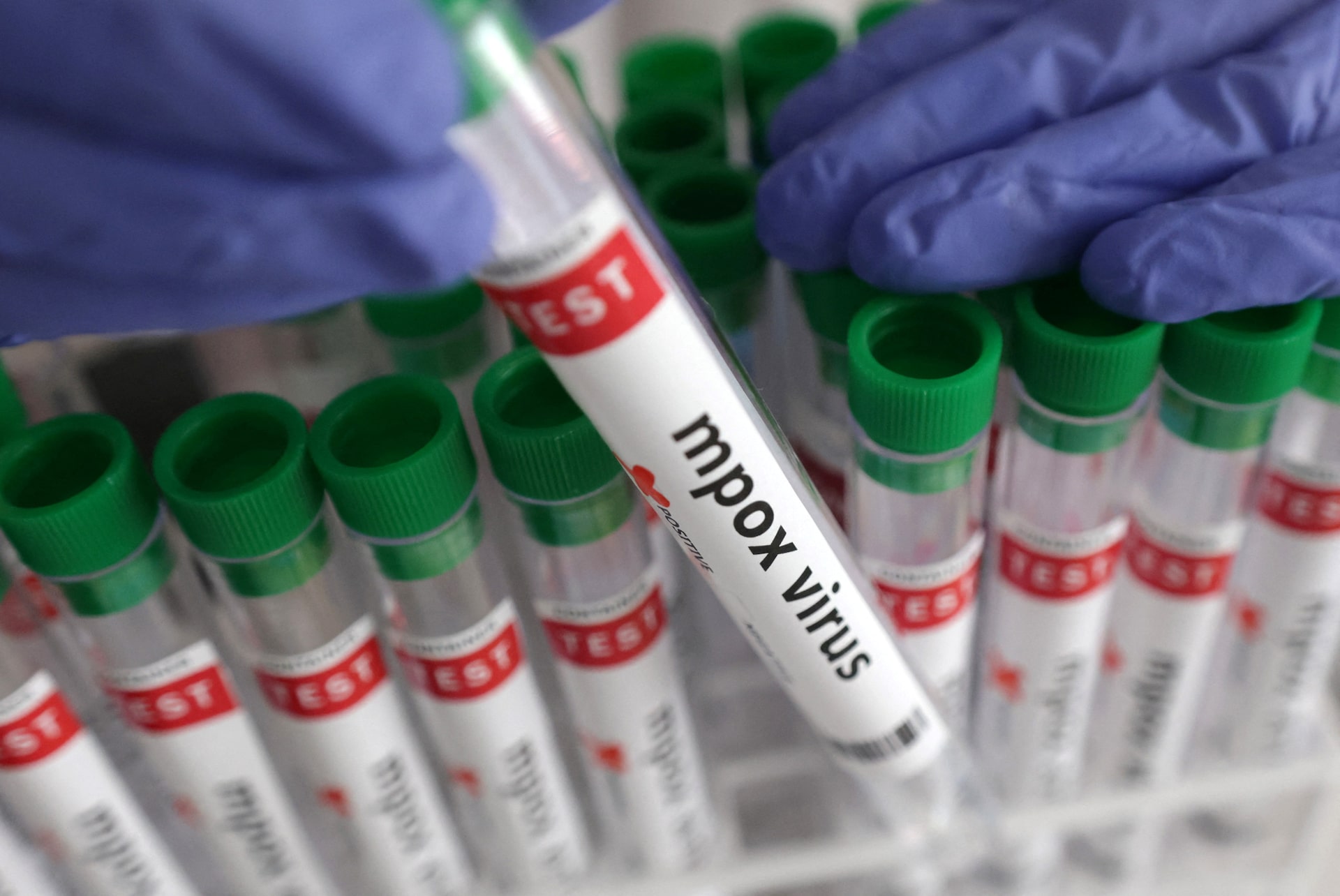 Bunia Confirms New Mpox Case Amid Strained Health Services and Ebola Outbreak
