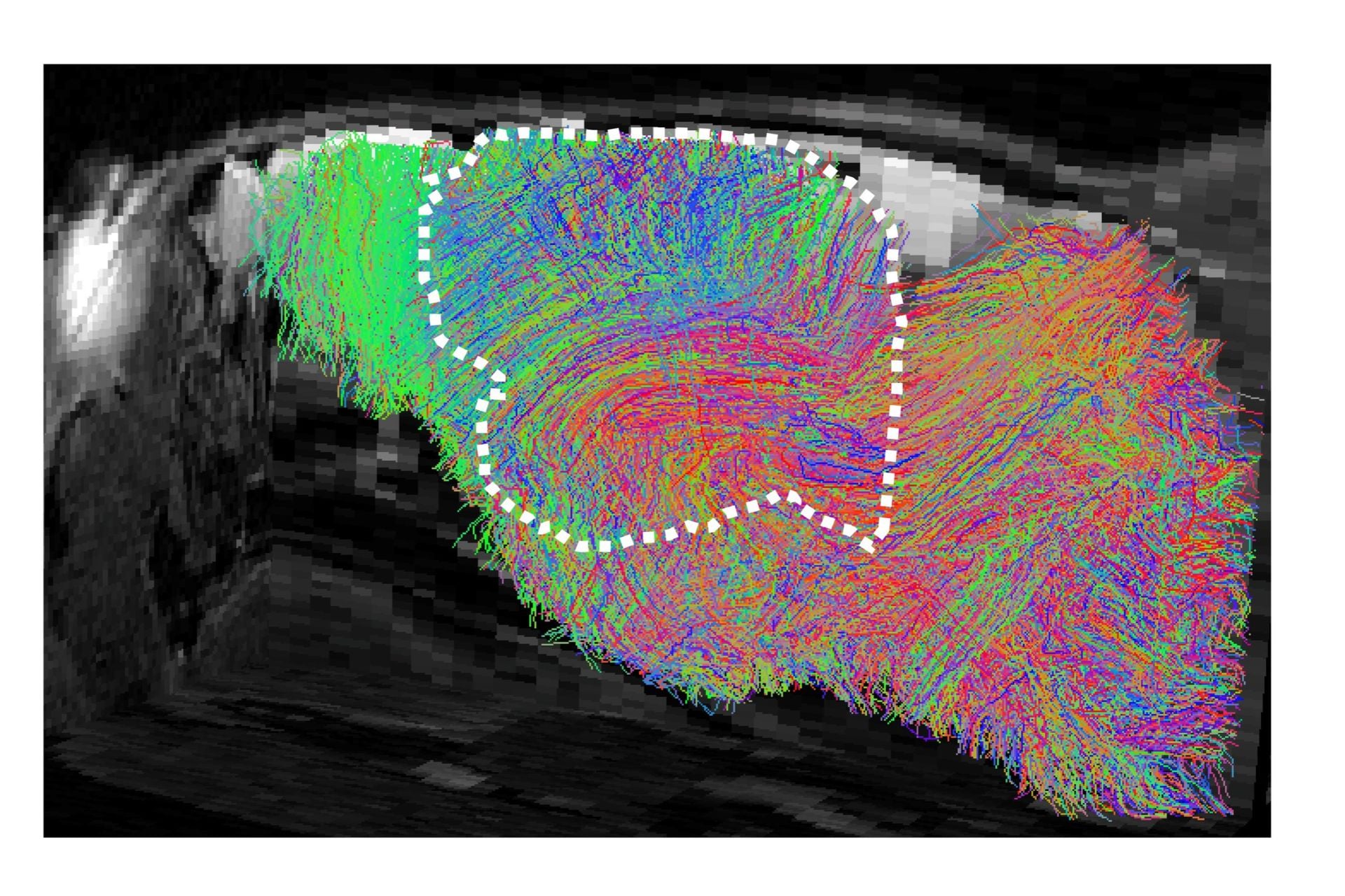 Stanford Researchers Transplant Human Brain Tissue Into Mice to Model Neurological Disorders