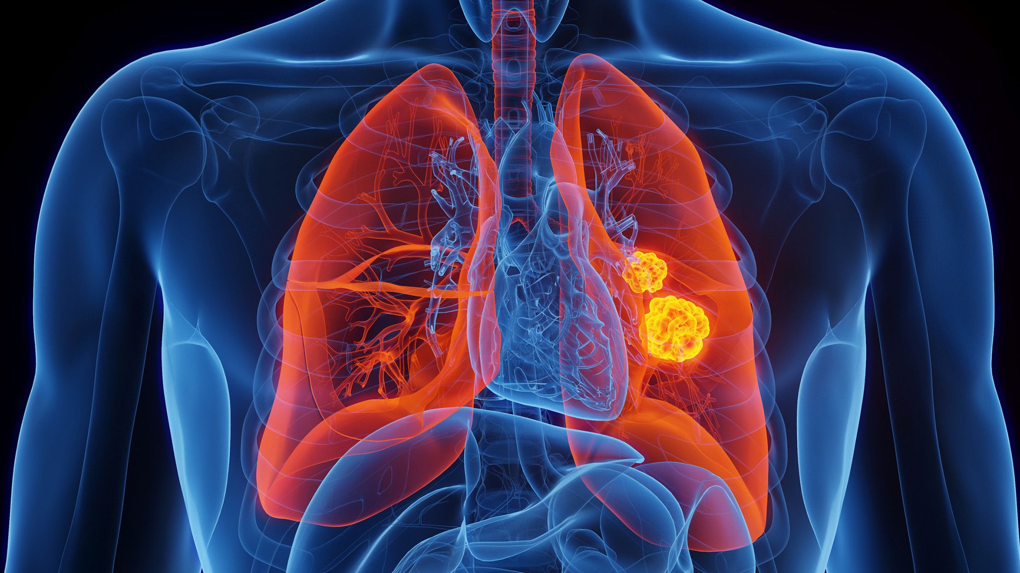 Rare Inherited Genetic Mutation Dramatically Increases Lung Cancer Risk for Nonsmokers
