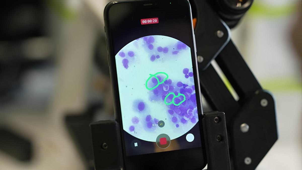 Llega a España un innovador tratamiento inmunoterápico para combatir el mieloma múltiple
