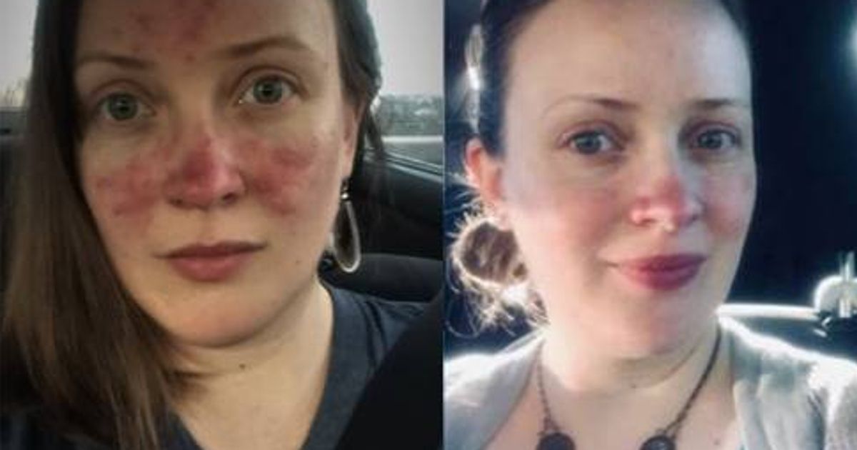 Former Model Praises Affordable Moisturiser for Transforming Her Rosacea-Prone Skin