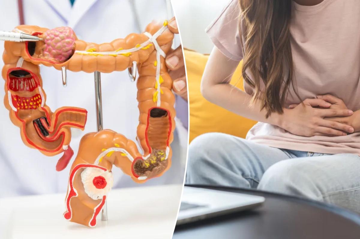 New Study Reveals Rising Colorectal Cancer Rates Among Teens and Young Adults