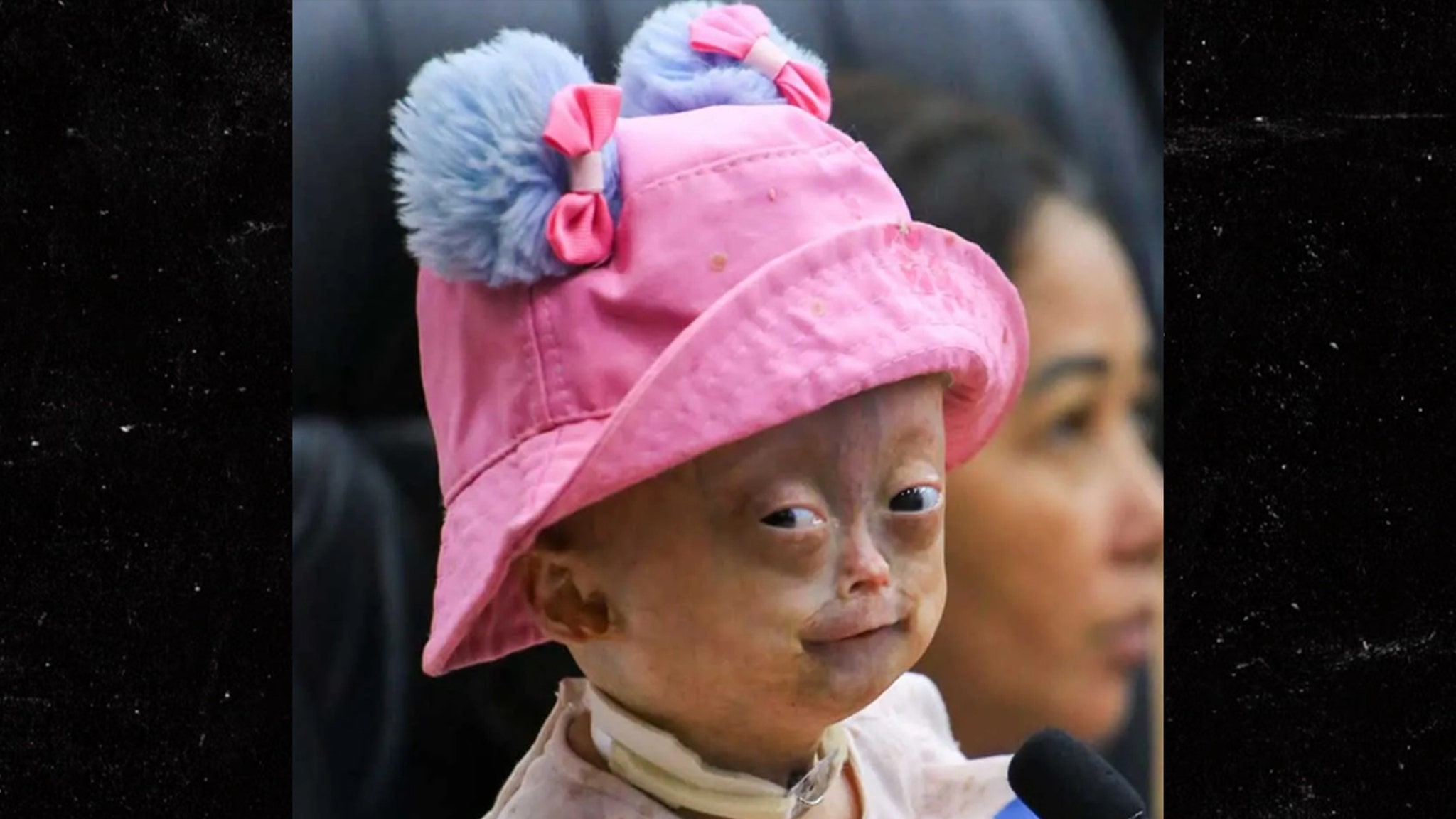 Brazilian Social Media Star Elis Lima Carneiro Dies at Age 5 From Progeria